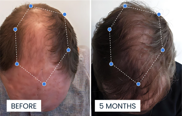 Före och efter — Anders C, 49